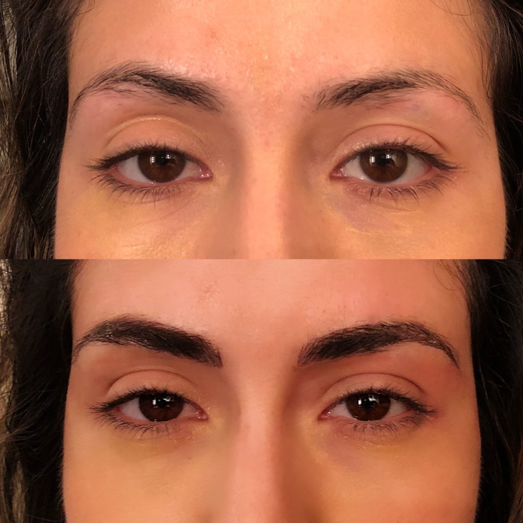 Stacey: "I love these eyebrows! What a difference!  Directly after initial microblade procedure.  We focused on adding a beginning and an ending to her brows, creating a lovely arch and shape."